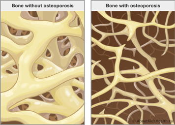 Bone without osteoporosis and bone with osteoporosis