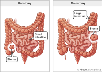 An ileostomy from the small intestine and a colostomy from the large intestine