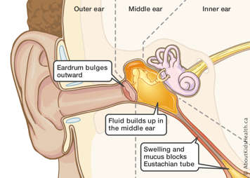 Eardrum bulging outward due to fluid buildup in middle ear from swelling and mucus blocks in Eustachian tube