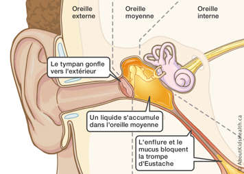 Un tympan gonfl&eacute; &agrave; cause de l'enflure et des blocages dans la trompe d'Eustache
