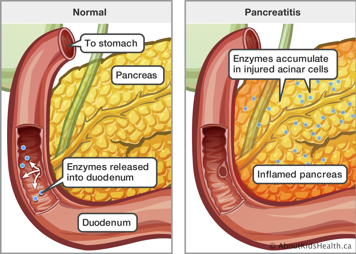 Normal enzyme release into duodenum compared to an inflamed pancreas with enzyme accumulation in injured acinar cells