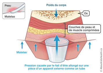 Pression sur l’os et les couches de peau et de muscle causée par être allongé sur un appareil externe montrée par des flèches