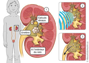 Illustration des calculs rénaux dans le rein pendant la lithotritie par ondes de choc