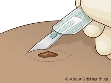 Illustration of excisional biopsy