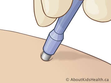 Illustration of punch biopsy