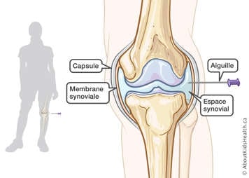 Une aiguille insérée dans l’espace synovial de l’articulation du genou