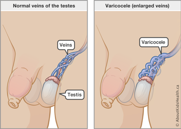 Illustration of normal veins of the testes and of varicocele (enlarged veins)