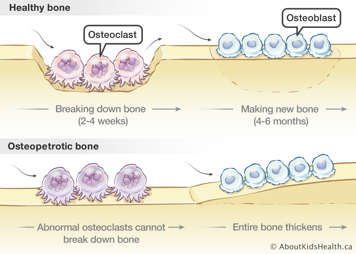 Osteopetrotic bone with abnormal osteoclasts compared to a healthy bone