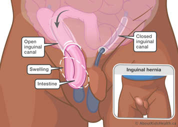 Part of the intestine bulges through an opening in the groin, causing swelling in the groin