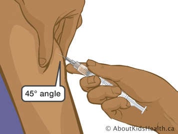 Inserting needle into upper arm at a 45-degree angle