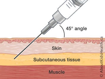 Cross-section of skin, subcutaneous tissue and muscle with needle injected at a 45-degree angle