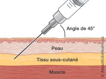 Coupe transversale de la peau, du tissu sous-cutan&eacute; et du muscle avec une aiguille inject&eacute;e &agrave; un angle de 45 degr&eacute;s