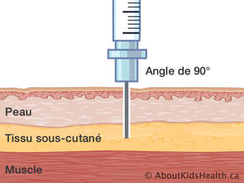 Le peau, le tissu sous-cutan&eacute; et le muscle avec une aiguille ins&eacute;r&eacute;e &agrave; un angle de quatre-vingt-dix degr&eacute;s