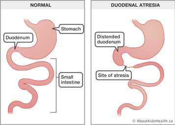 Normal stomach, duodenum and small intestine and an illustration of duodenal atresia with the site of atresia identified