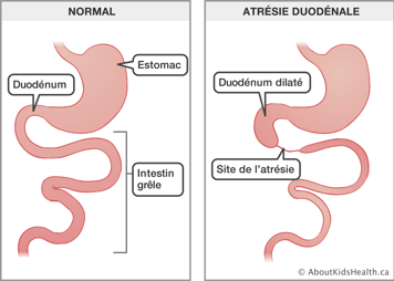 Estomac, duod&eacute;num et intestin gr&ecirc;le normaux et une illustration de l&rsquo;atr&eacute;sie duod&eacute;nale avec la site de l&rsquo;atr&eacute;sie identifi&eacute;e