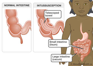 Location of small and large intestines in a child and close-ups on a normal intestine and an intestine with intussusception