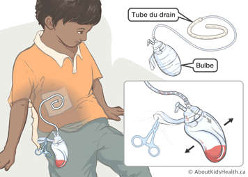 Tube du drain et bulbe d’un drain de Jackson Pratt attaché à un enfant