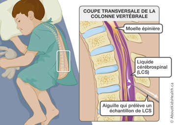 Coupe transversale de la colonne vertébrale avec une aiguille insérée pour prélever un échantillon de liquide cérébrospinal