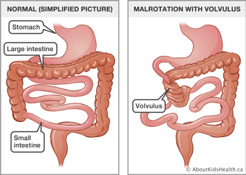 Simplified picture of normal stomach and small and large intestines, and an illustration of malrotation with volvulus