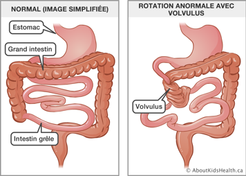 Image simplifi&eacute;e d&rsquo;un estomac, grand instestin et intestin gr&ecirc;le normaux, et illustration de rotation anormale avec volvulus