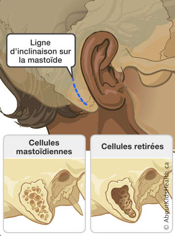 Ligne d’inclinaison sur la mastoïde et un gros plan sur l’os avec cellules mastoïdiennes et avec cellules retirées