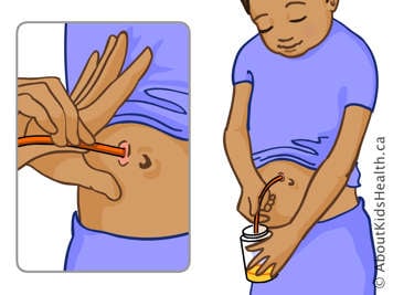 Inserting catheter and draining urine through catheter into jar