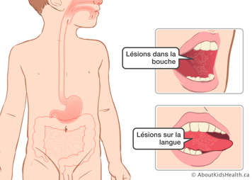 Des l&eacute;sions dans la bouche et sur la c&ocirc;t&eacute; de la langue