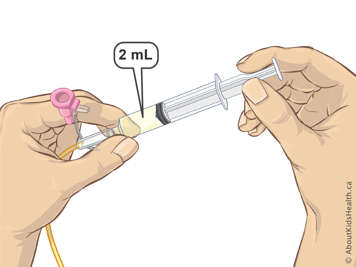 連接鼻胃管的注射器內有兩毫升液體