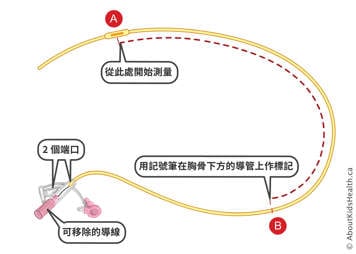 在帶有兩個端口和可拆卸導線的鼻胃管上做標記