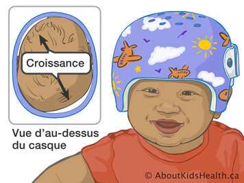 Bébé portant un casque orthopédique et une vue d’au-dessus de la tête dans le casque