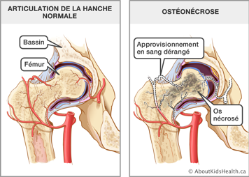 Articulation de la hanche normale et articulation de la hanche touchée par l’ostéonécrose