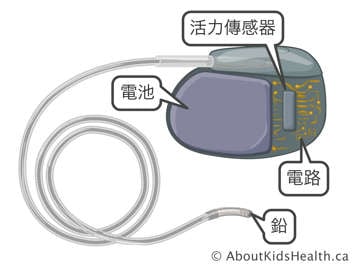 起搏器中的活力傳感器、電池、電路和鉛