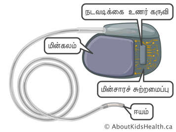 செயல்பாடு உணரி, மின்கலம், சுற்றோட்டத்துக்குத் தேவையானவை, இதயமுடுக்கித் தூண்டி