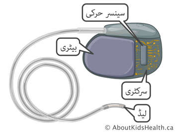 یکٹیوٹی سینسر، بیٹری، سرکٹری اور پیس میکر کی لیڈ