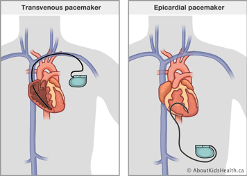 A heart with a transvenous pacemaker and a heart with an epicardial pacemaker