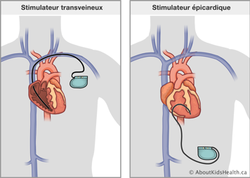 Le stimulateur transveineux dans une veine et le cœur et le stimulateur épicardiaque attaché à l’extérieur du cœur