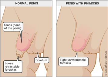 Normal penis with loose retractable foreskin and penis with phimosis with tight unretractable foreskin