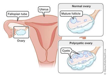 The uterus, fallopian tube and ovary, a normal ovary with a mature follicle, and a polycystic ovary with cysts