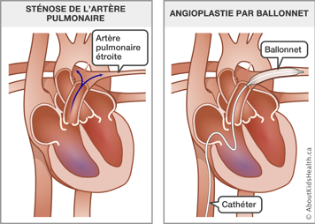 Cœur avec artère pulmonaire étroite et cœur avec un cathéter et un ballonnet insérés dans les aratères