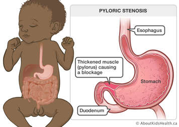 A baby's esophagus, stomach and duodenum, with a thickened muscle (pylorus) causing a blockage below the stomach