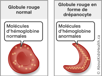 Une globule rouge avec les molécules d’hémoglobine normales et une globule rouge avec les molécules d’hémoglobine anormales