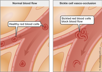 Normal blood flow with healthy red blood cells compared to blocked blood flow from sickled red blood cells