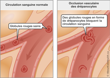 La circulation normale avec globules rouges sains et la circulation bloqu&eacute;e par des globules rouges en forme de dr&eacute;panocytes