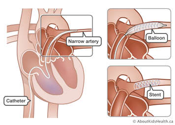 Catheter with balloon and stent inserted into narrow artery of the heart