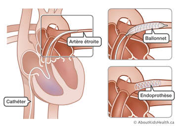 Un cathéter muni d’un ballonet et d’une endoprothèse inséré dans une artère étroite dans le cœur