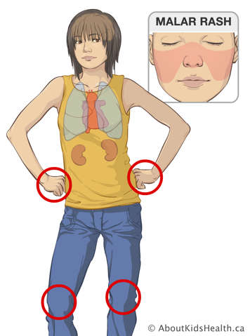 Identification of lungs, heart, kidneys, wrists and knees in a person with malar rash over the cheeks and nose