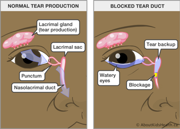 Eye with normal tear production and eye with blocked tear duct causing tear backup in the lacrimal sac and watery eyes