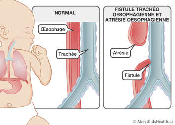 Illustration d&rsquo;un &oelig;sophage et d&rsquo;une trach&eacute;e normaux et illustration de fistule trach&eacute;o-&oelig;sophagienne et atr&eacute;sie &oelig;sophagienne