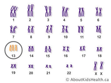 Pairs of chromosomes in a female with an extra copy of chromosome 13