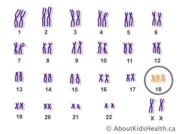 Les paires de chromosomes d’une femelle avec une copie supplémentaire du chromosome 18